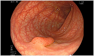 大腸内視鏡検査